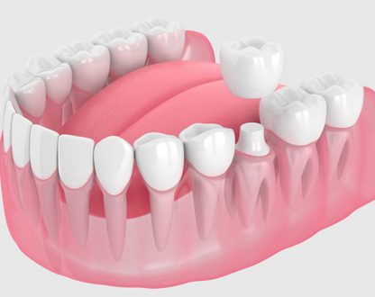 What are the advantages of a dental crown?