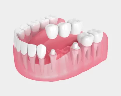 What Types of Dental Bridges Are Available in Old Saybrook, CT?